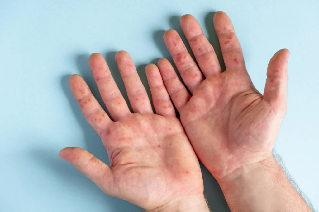 Atopická dermatitida (atopický ekzém)